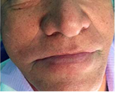 Evoluci�n del paciente 24h despues de transucrrido del evento adverso