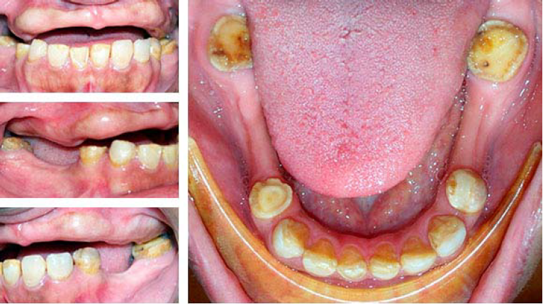 Caso 1 con diagn�stico presuntivo de AI del tipo hipomadura. Dientes anteriores y porteriores inferiores con alteraciones en el esmalte asociadas a hipomaduraci�n y fragmentaci�n por desgaste en los bordes incisales y superficies odusales