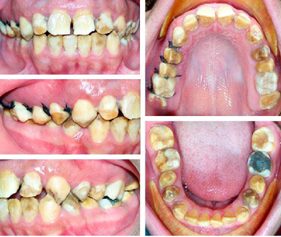 Caso 2 con diagnostico presuntivo de AI del tipo hipopl�sica. Dientes anteriores y posteriores superiores e inferiores con zonas blancas en las que el esmalte persiste y zonas pardas con manchas marrones oscures presentes en la dentina en las que hay ausencia de esmalte por no formaci�n o por fragmentaci�n del mismo. Es posible observar zonas de esmalte liso y opaco, con aspecto de copo de nieve, rugoso y fragmentado asociado a hipomaduraci�n y fragmentaci�n por desgaste