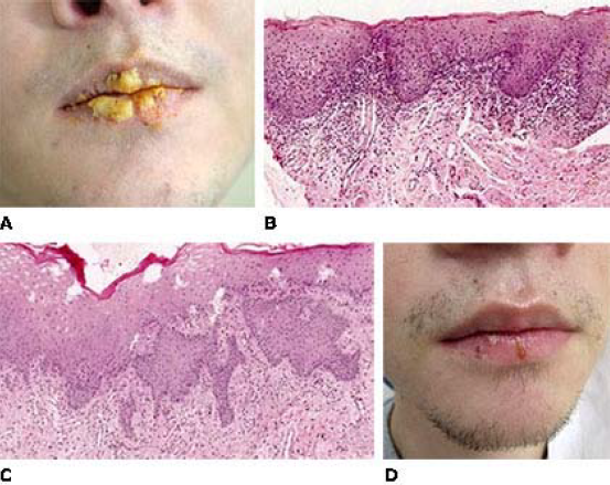 A: Imagem clínica extraoral dos lábios evidenciado crostras destacáveis de formato irregular, consistencia firme e coloracao amarelada. B-40X e C-100x H/E: Características histopatológicas onde se verifiva epitélio pavimentoso estratificado como espessamiento da camada superficial de ceratina, exibendo exocitose, degeneracao hidrópica; e a presenca de moderado indiltrato inflamatorio mononuclear na lamina própria. D: Imagen clínica extraoral após láserteraia.