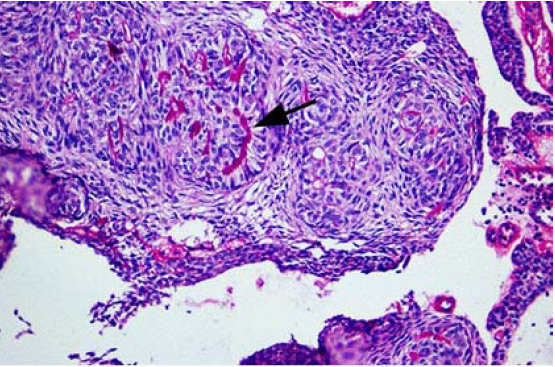Tumor odontognico adonomatoide. Materiaal esonfilo amorfo, positivoa la tincin del cido peridico de Schiff (flecha). X40 PAS