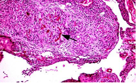 Tumor odontognico adenomatoide. Ndulos slidos de clulas epiteliales cuboidales (rosetas) que contienen material eosinfilo amorfo (flecha). reas microqusticas con bandas de epitelio de aspecto cribiforme (flecha). X40  HyE