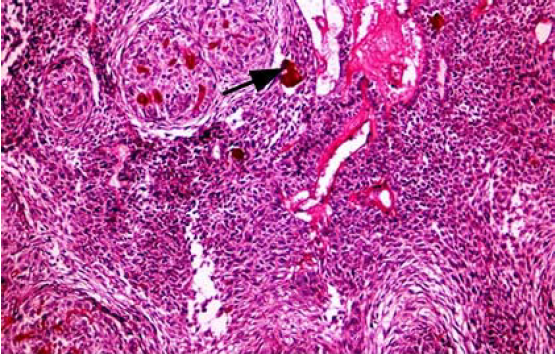 Tumor odontognico adenomatoide. Estroma con vsos sanguneos de pared fina y calcificaciones distrficas (flechas). X40 HyE