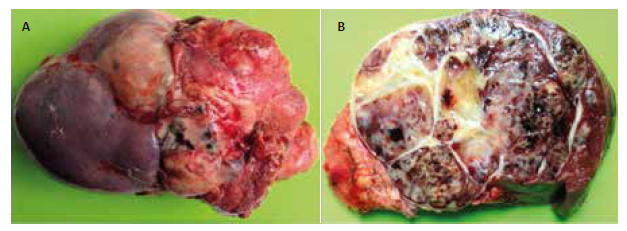 Macroscopía post- esplenectomía que muestra zona de superficie irregular con características quísticas (A). Bazo de 1800 mg de 22x17x12cm, con zonas mixoides, hemorrágicas y necróticas, y 30% de áreas calcificadas (B).