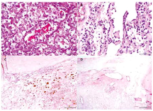(A) Tinción hematoxilina eosina (H&E), 100x: canales vasculares con células endoteliales altas, otras de aspecto histiocitario. (B) H&E, 100x: vasos con endotelio alto y proyecciones papilares. (C) H&E, 40x: hemofagocitosis. (D) H&E, 20x: cristales de colesterol y reacción xantomatosa.