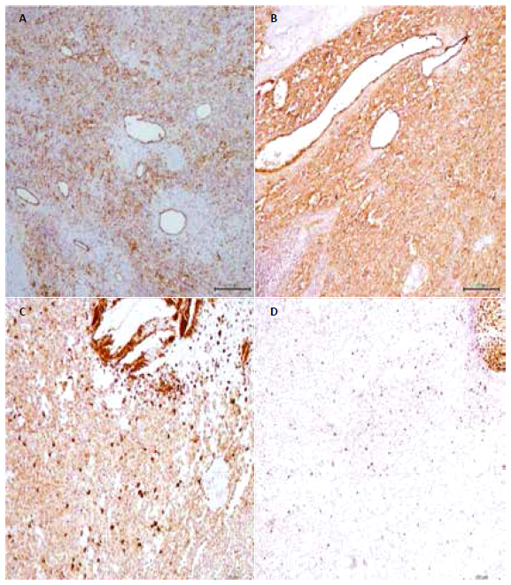 (A) Tinción de Inmunohistoquímica para CD31positiva, 40x. (B) Tinción con Factor VIII positiva, 40x. (C) Tinción con CD68 positiva en células histiocíticas, 40x. (D) Tinción con Ki67 positivo sólo parcialmente, 20x.