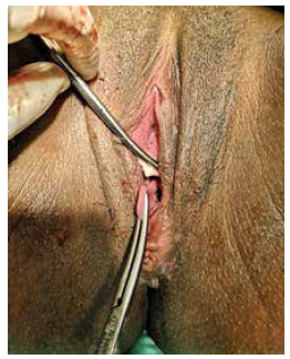 Segunda etapa del trabajo de parto. Con la cabeza del feto en el canal vagina, se sujetó el tabique en ambas bases con pinzas Kelly y se realizó una sección medial.