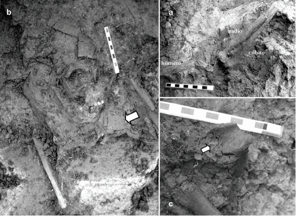 a:
Vista de la posici&oacute;n anat&oacute;mica articulada de los huesos del brazo izquierdo; b:
Detalle del aplastamiento y desplazamiento de piezas del cr&aacute;neo(flecha indica
ubicaci&oacute;n del fragmento de cer&aacute;mica sobre el t&oacute;rax del individuo); C: Detalle
del n&oacute;dulo de ocre rojo hallado sobre el h&uacute;mero izquierdo.