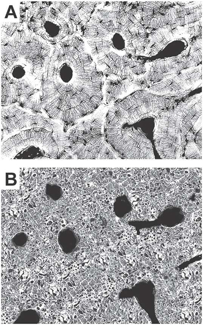 Representaci&oacute;n ideal de los extremos del &Iacute;ndice Histol&oacute;gico (IH): (A) IH=5; B) IH=0. N&oacute;tese la p&eacute;rdida de rasgos histol&oacute;gicos caracter&iacute;sticos en (B) (i.e. lamelas, lagunas, canal&iacute;culos; l&iacute;neas de cemento), debido a la apariencia espongiforme adquirida extensivamente por el hueso; en la imagen, s&oacute;lo resultan reconocibles los canales de Havers y de Volkmann.