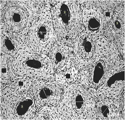 Microfotograf&iacute;a - Tejido cortical de f&eacute;mur (100x). Individuo femenino, 63 a&ntilde;os. Referencias: c&iacute;rculos: osteonas secundarias completas (N. On.), estrella color negro: osteonas fragmentarias (N. On. Fg.), l&iacute;nea blanca: di&aacute;metro conducto de Havers (Hav. Can).