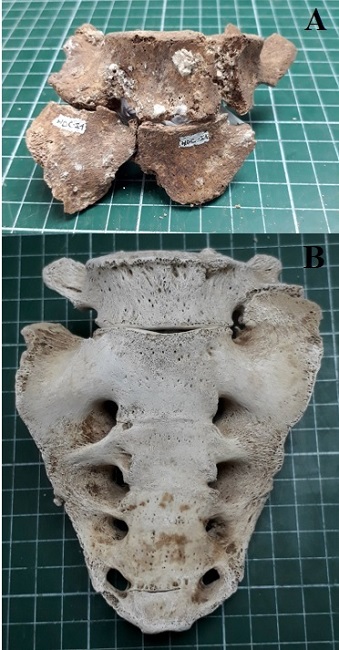 A. Vista anterior de fragmento de sacro con presencia de sacralización incompleta unilateral derecha de L5 del individuo del sitio Hornos de Cal. 3. B. Vista anterior del sacro con sacralización incompleta de L5 unilateral izquierda del individuo del sitio CEFA-1