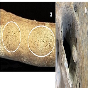 (a) Reacci&oacute;n periostal inactiva en f&eacute;mur derecho (adulto femenino). (b) Exostosis auditiva en canal auditivo izquierdo (adulto masculino).