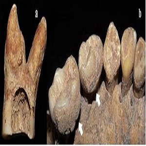 (a) Caries en primer molar superior izquierdo (adulto femenino). (b) C&aacute;lculos en molares inferiores izquierdos (juvenil)