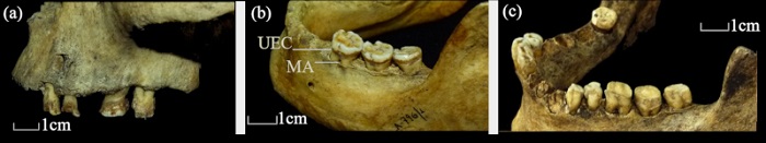 Expresi&oacute;n de la periodontitis en las arcadas dentales. (a) Individuo MFM 796 mand&iacute;bula izquierda, grado 3; (b) Individuo MFM 795, maxilar izquierdo, grado 2; (c) Individuo Shamakush caja 7, mand&iacute;bula izquierda, grado 3. Referencias: UEC: uni&oacute;n esmalte-cemento; MA: margen alveolar.