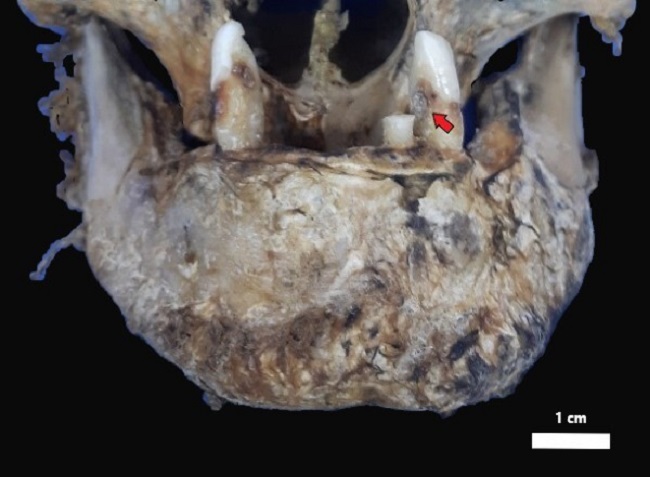 Vista frontal de la mand&iacute;bula inferior mostrando detalles del estado de dentici&oacute;n. La flecha roja indica un proceso de carie en faceta mesial del canino.