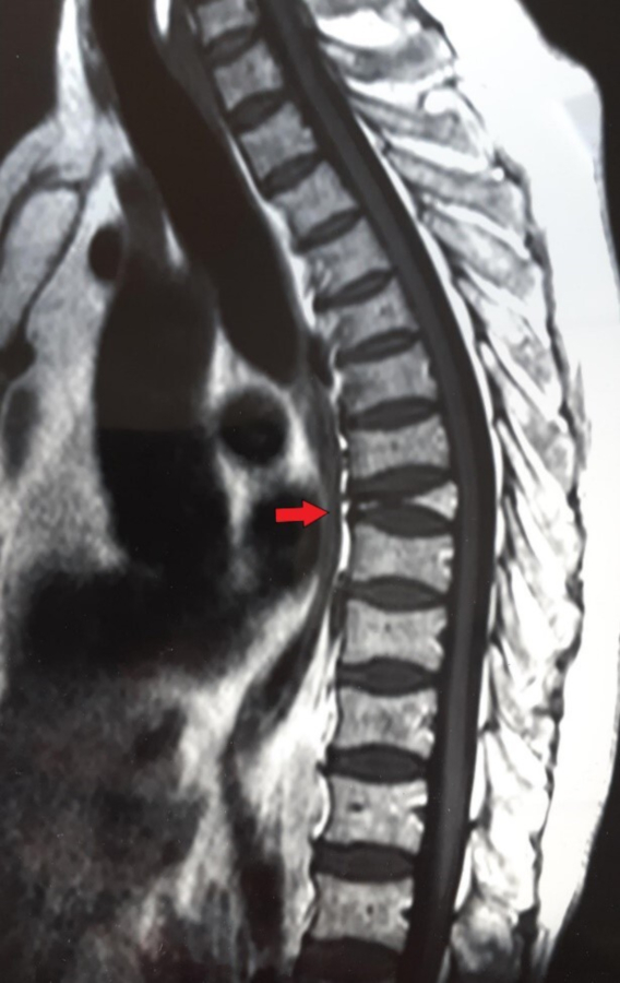 Resonancia Magn&eacute;tica Nuclear. La flecha roja muestra platispondilia traum&aacute;tica de la v&eacute;rtebra D8.