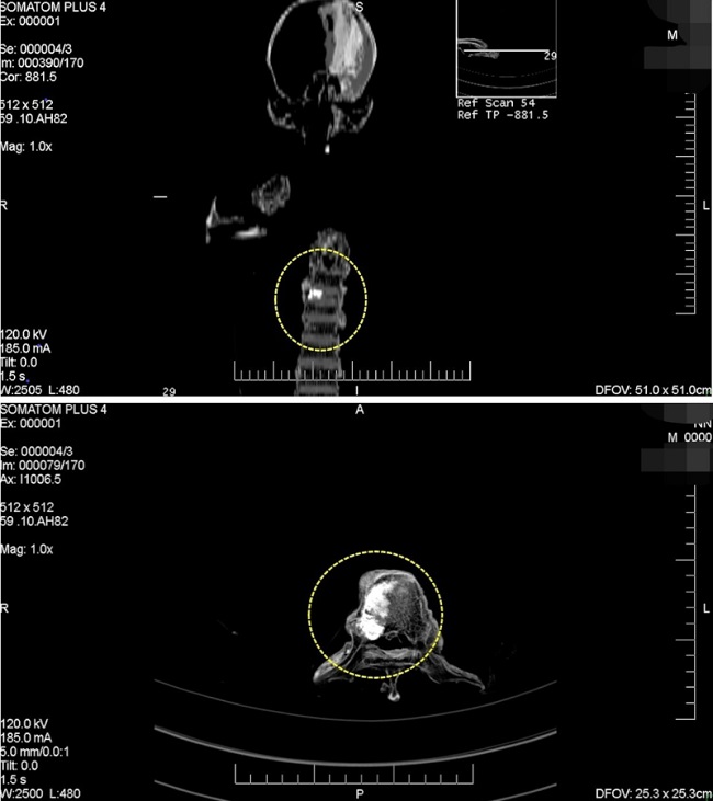 Tomograf&iacute;a Axial Computada (TAC) identificando una patolog&iacute;a en 8 dorsal.