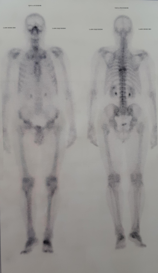 Centellograma ante mortem con hipercaptaci&oacute;n del radiotrazador en columna dorsal localizando la misma patolog&iacute;a.