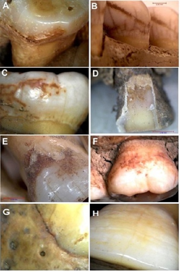 Indicadores observados. A) Segundo molar inferior derecho (R&iacute;o Cuarto; caso 292/11) con pigmentaci&oacute;n parda; &iacute;ndice de Dean: 3. B) Segundo premolar inferior derecho (Corral de Piedras; caso CPI107) con pigmentaci&oacute;n parda lineal; &iacute;ndice de Dean: 3, porosidad en tabla alveolar: 3. C) Primer molar inferior izquierdo (Villa de Soto; caso 634/12, cr&aacute;neo 38) con pigmentaci&oacute;n parda difusa; &iacute;ndice de Dean: 3. D) Primer premolar superior derecho (Piedras Blancas, Nono; caso 1425/18) con fractura, desprendimiento de esmalte y pigmentaci&oacute;n; &iacute;ndice de Dean: 4; E) Canino superior derecho (Campo Sismondi; caso 648/15) con textura de la superficie de aspecto irregular y corro&iacute;do; &iacute;ndice de Dean: 4. F) Primer molar superior derecho (Punta del Silencio, caso 932/18) con pigmentaci&oacute;n oscura; &iacute;ndice de Dean: 3. G: Tabla &oacute;sea alveolar del maxilar inferior lado derecho, con pigmentaciones oscuras y porosidad aumentada (Punta del Silencio; caso 932/18). H) Incisivo central superior izquierdo (Dean Funes, caso 1591) con l&iacute;neas adamantinas claras y oscuras; &iacute;ndice de Dean: 3.