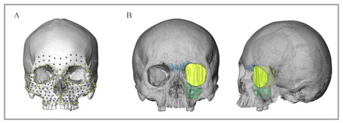 Morphometric analysis. A. Landmarks and semilandmarks of contours (green) and semilandmarks of surfaces (black) digitized on the facial skeleton. B. Craniofacial cavities segmented: maxillary sinus (green), frontal sinus (blue), orbital capsule (yellow).