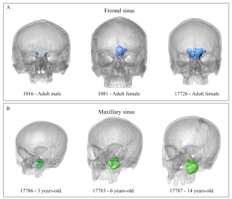 Examples of segmentation of the frontal and maxillary sinus. The upper panel shows examples of three individuals from the same age group but that differ in the size and shape of the frontal sinus (A). The lower panel shows the changes in size with age in the maxillary sinus (B).
