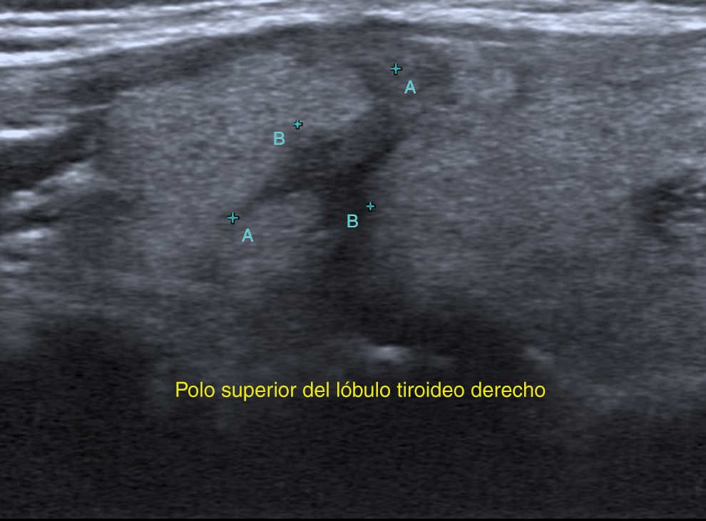 En escala de grises se visualiza un área hipoecoica de morfología poliédrica, ubicada en el polo superior del lóbulo tiroideo derecho.