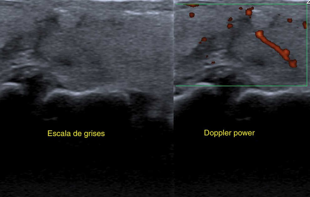 En el power Doppler se evidencia una escasa vascularización periférica.