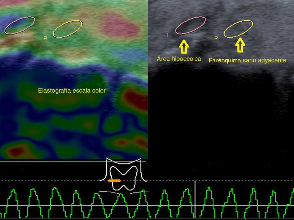 La elastografía por compresión identifica un área predominantemente elástica, valorada con escala de color y strain ratio (la escala color utilizada comprende desde el rojo suave hasta un azul intenso).