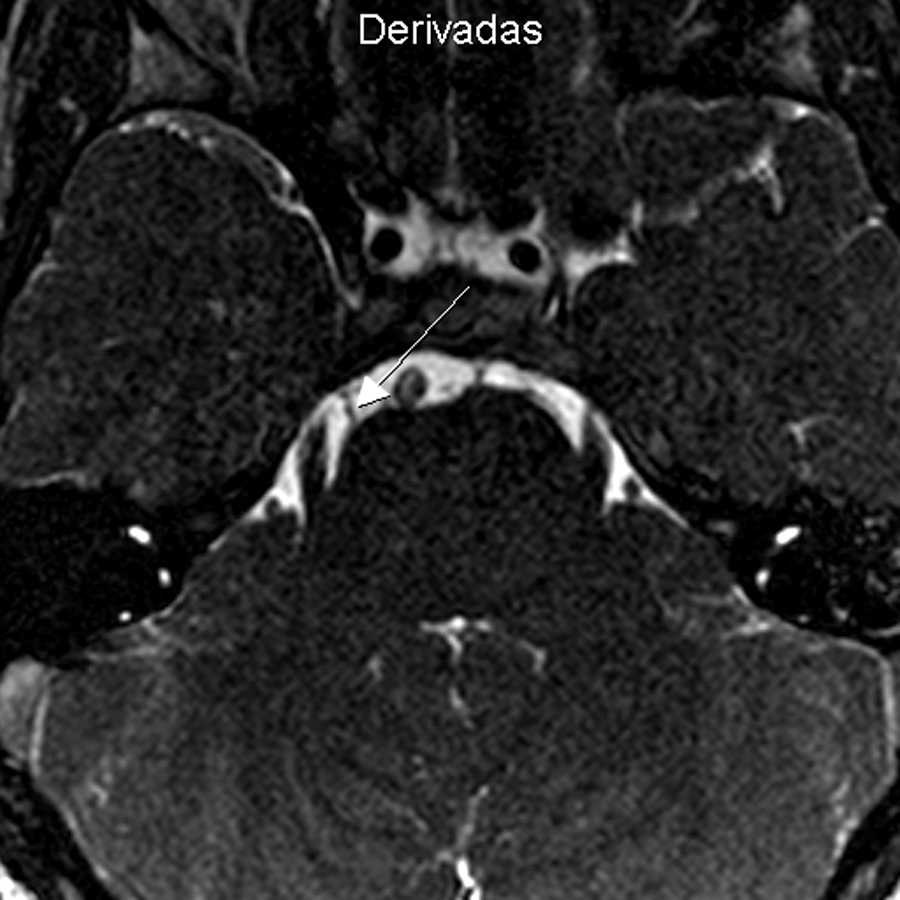 Resonancia magnética a nivel de la fosa posterior, en secuencia ponderada en T2 corte axial y BFFE, muestra la entrada del sexto par derecho ingresando al canal de Dorello (flecha). Compárese la ausencia del sexto nervio craneal contralateral.