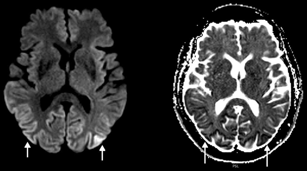Secuencia axial de difusi&oacute;n isotr&oacute;pica y mapa de coeficiente de difusi&oacute;n aparente (ADC): hiperintensidad de se&ntilde;al en la corteza parieto-occipital bilateral, que se muestra hipointensa en el mapa de ADC (flechas), confirm&aacute;ndose la restricci&oacute;n a la difusi&oacute;n.