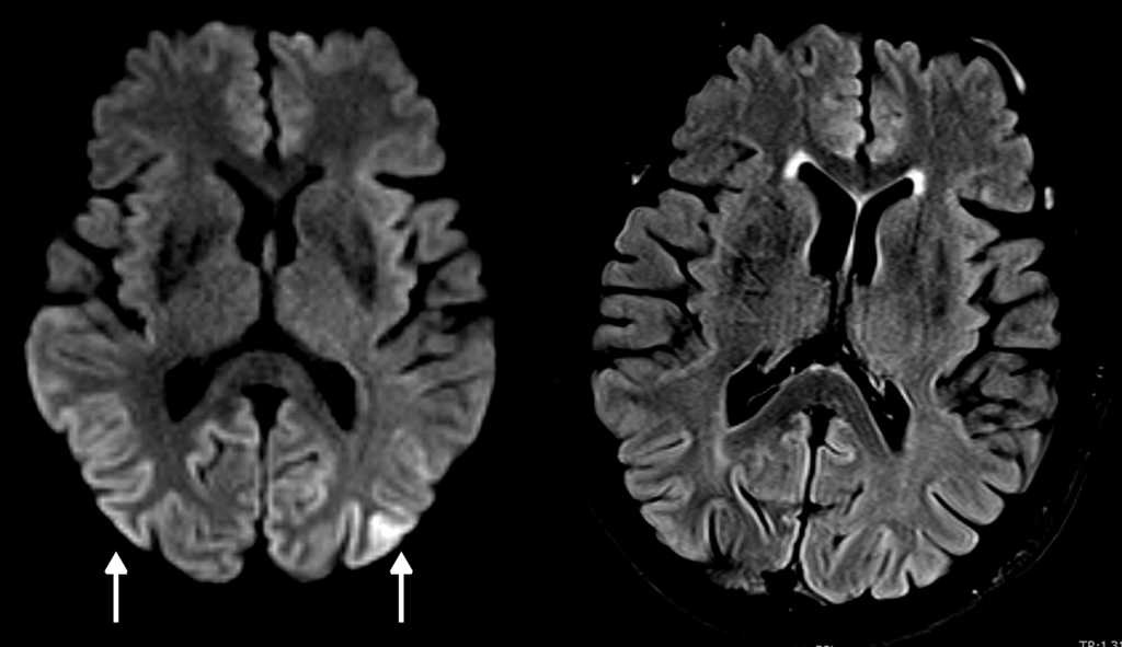 Secuencias axial de difusi&oacute;n y FLAIR: hiperitensidad cortical parieto-occipital bilateral (flechas) en la secuencia DWI en equipo de 3T, mucho menos evidentes en la secuencia FLAIR. La secuencia de difusi&oacute;n es la m&aacute;s sensible para las alteraciones corticales.
