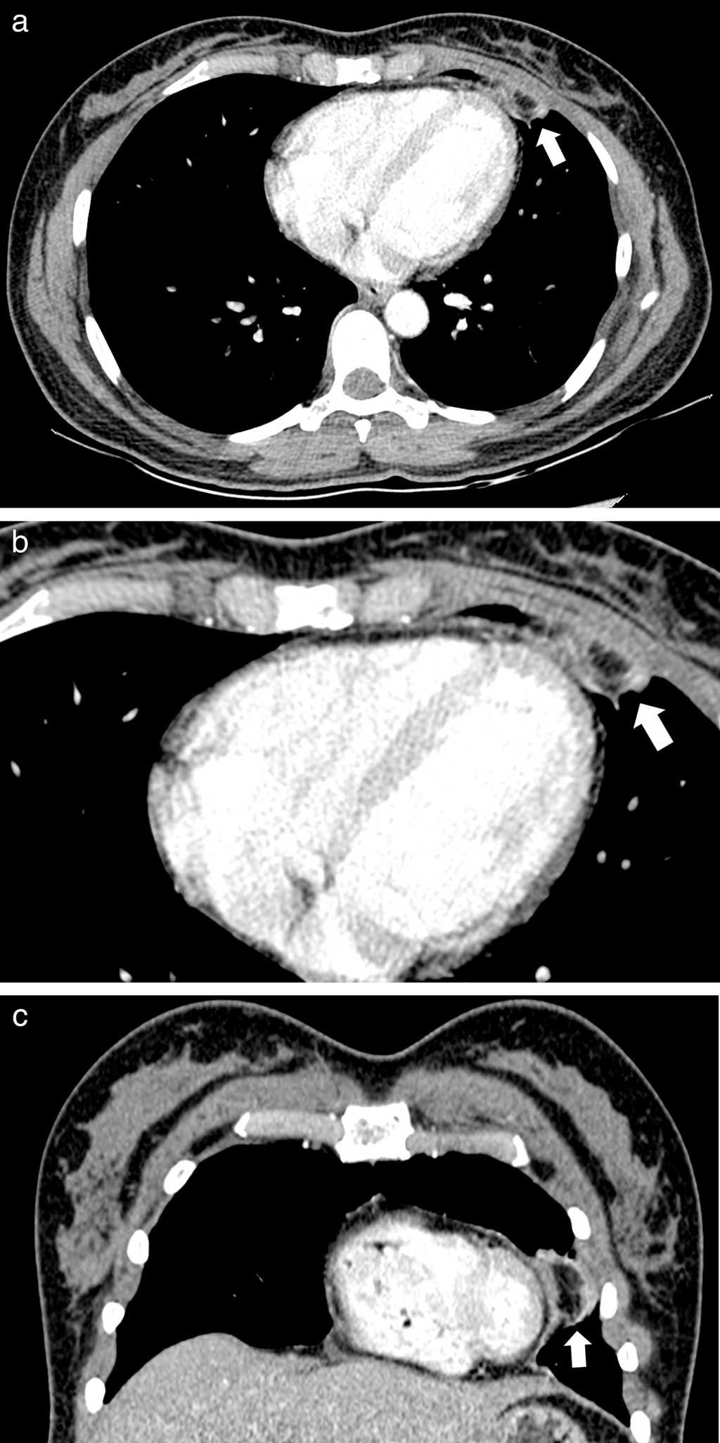 Mujer de 35 años presenta en (a) la TC de tórax contrastada en corte axial con ventana de tejidos blandos una lesión ovoidea encapsulada, con atenuación grasa y presencia de anillo de tejido blando con aumento en la atenuación de la grasa adyacente, localizada en la región epicárdica anterior del lado izquierdo (flecha). (b) La TC de tórax contrastada en el área epicárdica izquierda muestra la lesión encapsulada de baja atenuación (flecha). (c) La reconstrucción coronal de la TC confirma la falta de continuidad con el tejido graso infradiafragmático o mediastinal (flecha).
