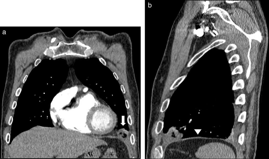 Hombre de 67 años presenta en (a) la angiografía por TC de tórax con reconstrucción coronal y ventana de tejidos blandos una lesión redondeada con atenuación central grasa, de mayor densidad periférica en la localización de la grasa epicárdica anterior hacia el ángulo cardiofrénico izquierdo (flecha). (b) La reconstrucción sagital de la TC confirma la falta de continuidad con el tejido graso infradiafragmático y evidencia diafragma íntegro (cabeza de flecha).
