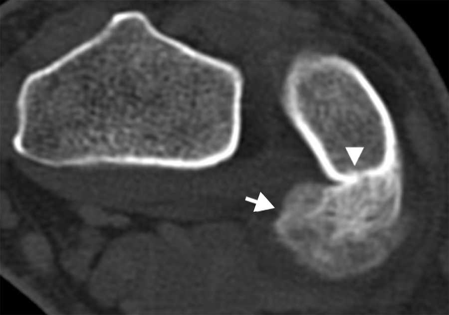 Tomografía computada de muñeca en el plano axial con lesión ósea yuxtacortical, bien delimitada (flecha), en continuidad con la cortical ósea cubital (cabeza de flecha).