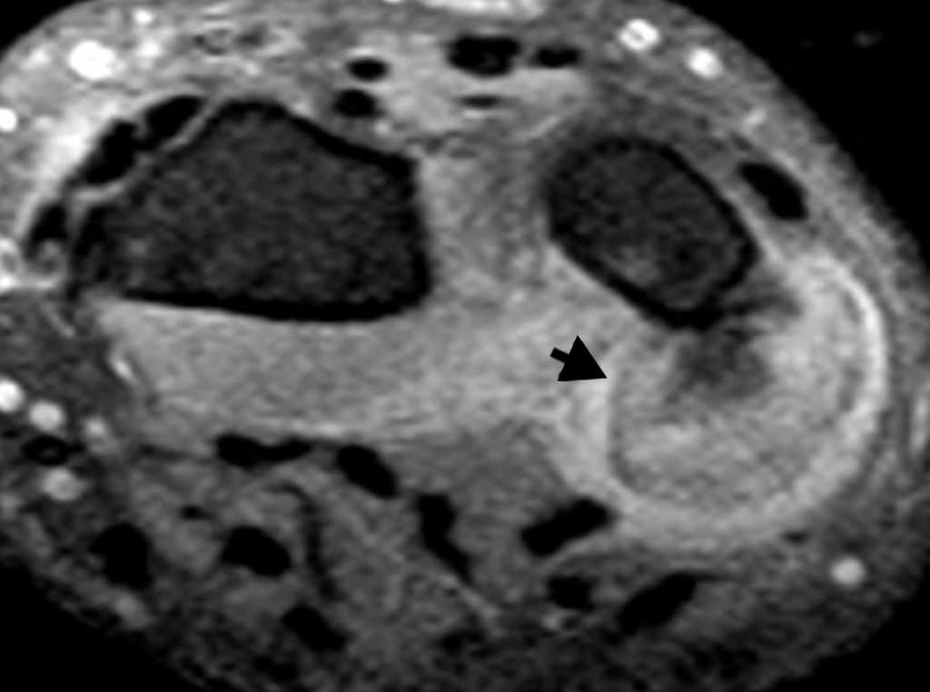 Resonancia magnética de muñeca en plano axial con secuencia potenciada en T2 con saturación espectral de la grasa (Fat Sat) visualiza una lesión compatible con POPB, de bordes bien delimitados, intensidad de señal alta y discretamente heterogénea (flecha), con ausencia de afectación medular.