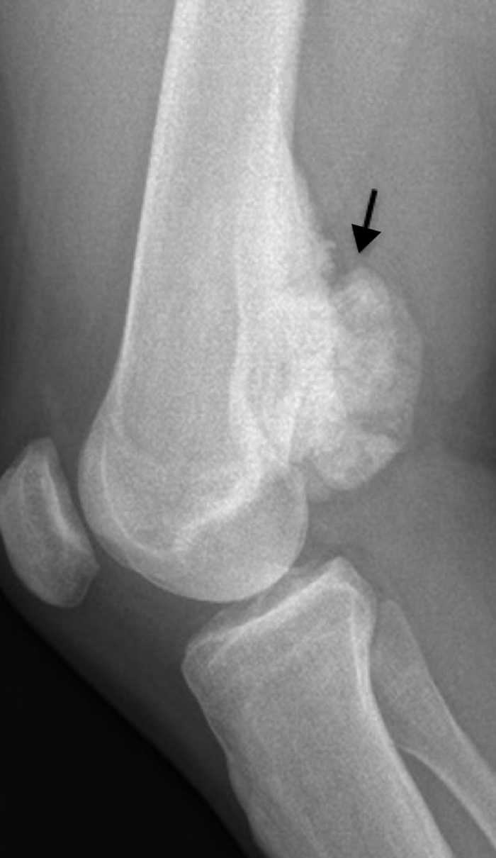 Radiografía simple lateral de la rodilla derecha muestra una lesión calcificada de localización metafisodiafisaria en el fémur distal (flecha).