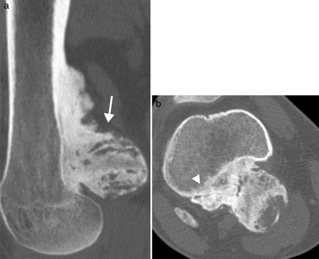 La tomografía computada de rodilla evidencia (a) en plano sagital una lesión dependiente de la cortical posterior del fémur (flecha) y (b) en plano axial una lesión dependiente de la cortical y esclerosis de la medular periférica, sugestiva de afectación de la misma (cabeza de flecha).