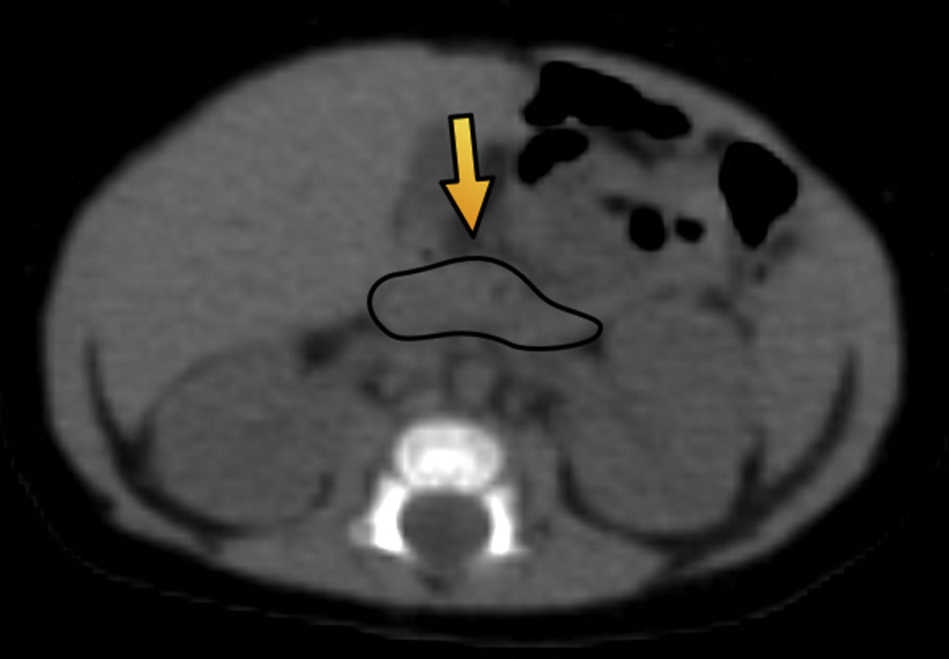 Tomograf&iacute;a computada de abdomen en plano axial muestra un par&eacute;nquima pancre&aacute;tico delimitado por una l&iacute;nea negra (flecha) de configuraci&oacute;n habitual, sin evidencia de lesiones focales.