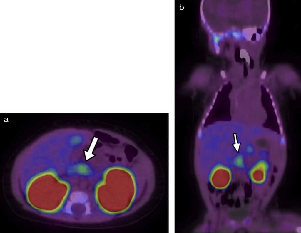 18F-DOPA PET/TC en (a) plano axial al mismo nivel que la  y (b) en plano coronal evidencia una imagen focal de alta avidez por el radiotrazador (flechas blancas). Tambi&eacute;n se destacan sitios de captaci&oacute;n fisiol&oacute;gica de18F-DOPA, como la ves&iacute;cula biliar y los ri&ntilde;ones.