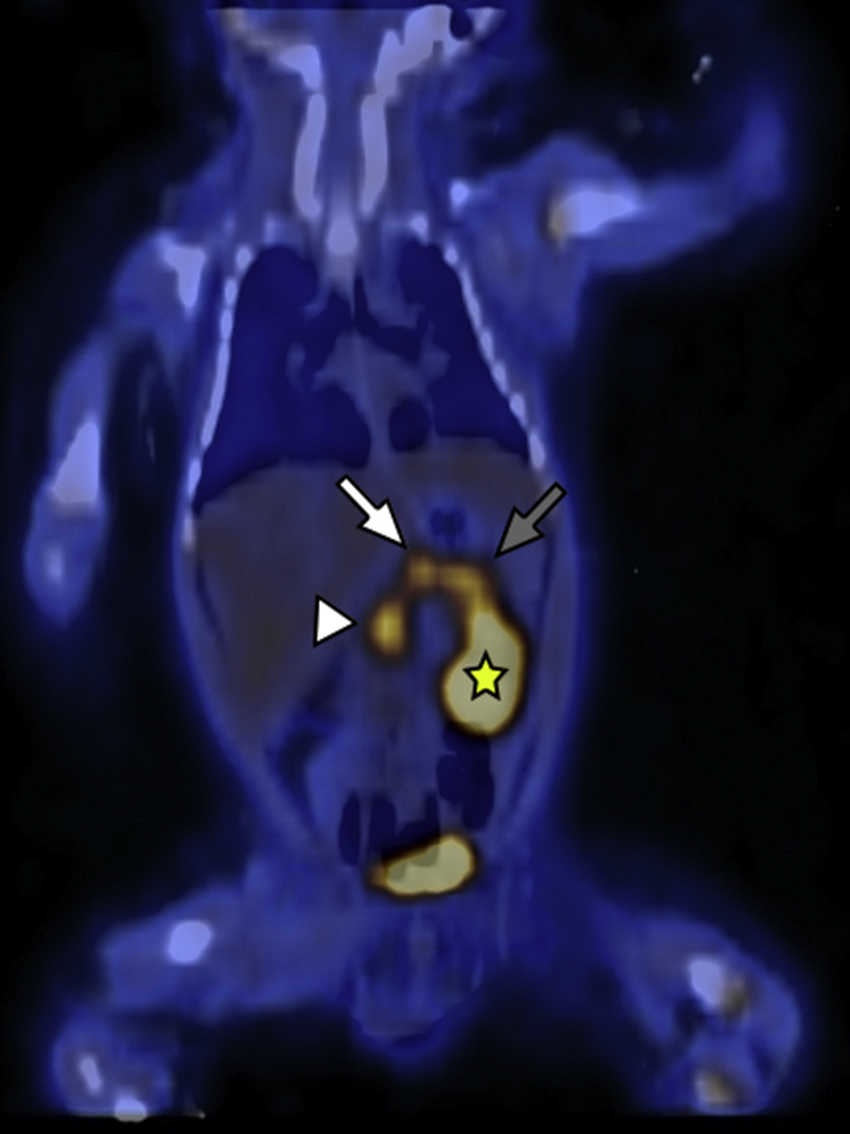 18F-DOPA PET/TC en plano coronal identifica a nivel del par&eacute;nquima pancre&aacute;tico una acumulaci&oacute;n difusa del radiotrazador y tres focos hipermetab&oacute;licos a nivel de la cabeza (cabeza de flecha), cuerpo (flecha blanca) y cola (flecha gris). Se se&ntilde;ala, adem&aacute;s, el ri&ntilde;&oacute;n izquierdo (estrella amarilla) excretando el radiotrazador.