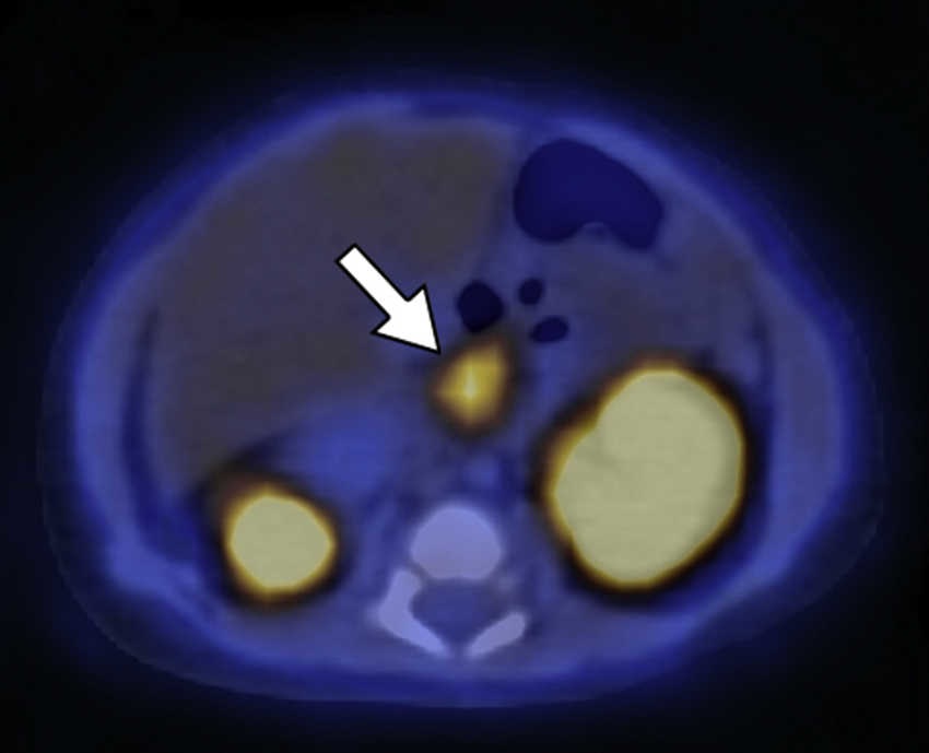 18F-DOPA PET/TC en plano axial del mismo paciente que la  muestra una de las zonas de acumulaci&oacute;n patol&oacute;gica del radiotrazador localizada en la cabeza pancre&aacute;tica.