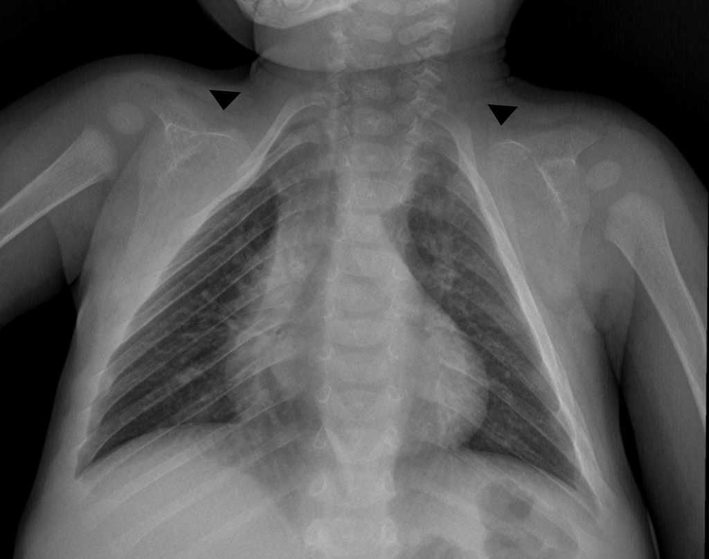 Radiografía anteroposterior de tórax muestra la apariencia triangular del tórax, con ausencia congénita de ambas clavículas (cabezas de flechas).