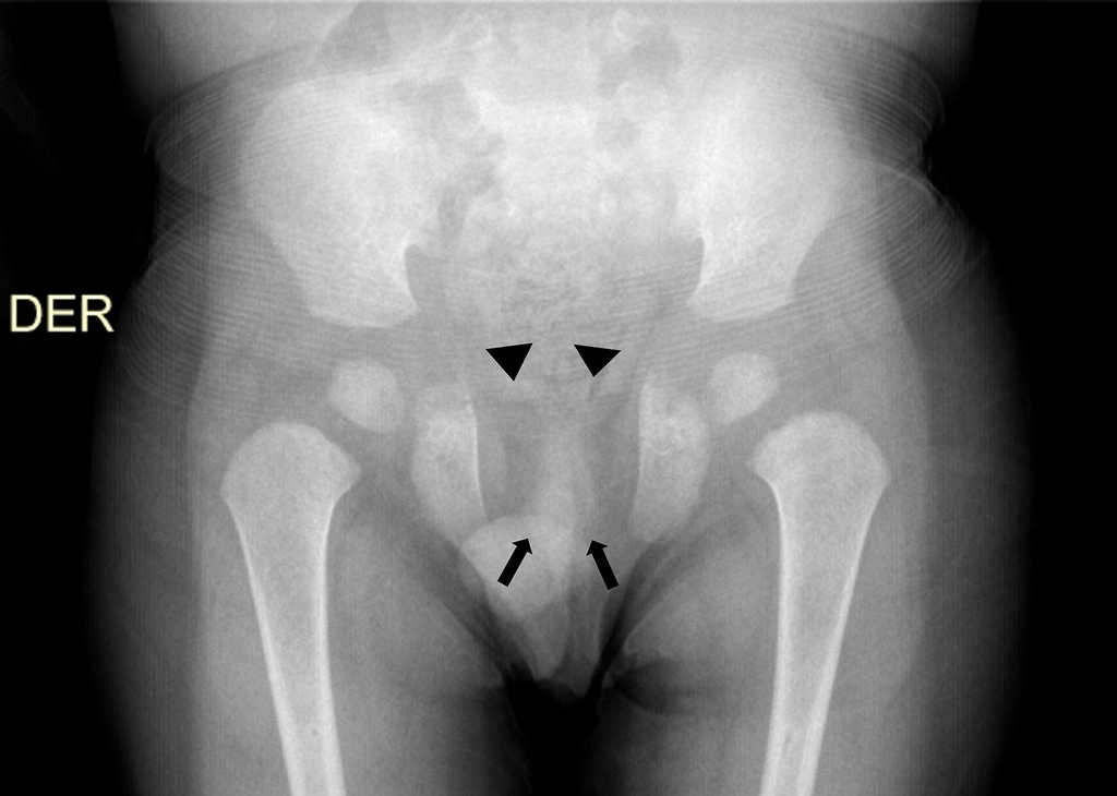 Radiografía anteroposterior de pelvis evidencia ausencia de osificación de las ramas iliopúbicas (cabezas de flechas) y osificación parcial del isquion, con ausencia de las ramas isquiopúbicas (flechas).