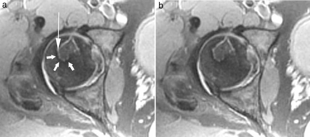 (a) Secuencia de densidad prot&oacute;nica con supresi&oacute;n grasa en el plano axial muestra el signo de la doble l&iacute;nea. Se visualizan dos l&iacute;neas adyacentes entre s&iacute;, la externa hipointensa (flechas cortas) y la interna hiperintensa (flecha larga), siguiendo la interfase entre el hueso normal y el necr&oacute;tico. (b) Se observa el signo de la doble l&iacute;nea sin iconos superpuestos.
