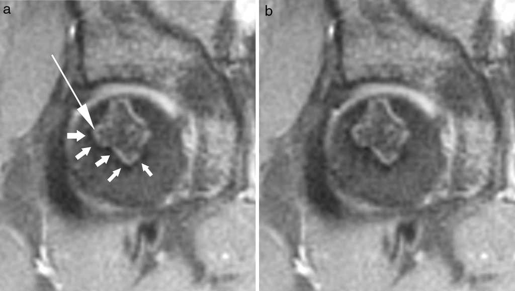 (a) Secuencia de densidad prot&oacute;nica con supresi&oacute;n grasa en el plano coronal, correspondiente al mismo paciente, muestra el signo de la doble l&iacute;nea. Se visualizan dos l&iacute;neas adyacentes entre s&iacute;, la externa hipointensa (flechas cortas) y la interna hiperintensa (flecha larga), siguiendo la interfase entre el hueso normal y el necr&oacute;tico. (b) Se observa el signo de la doble l&iacute;nea sin iconos superpuestos.