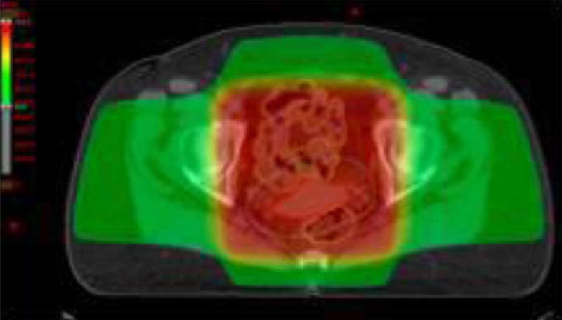 Distribuci&oacute;n de dosis seg&uacute;n t&eacute;cnica de radioterapia tridimensional conformada.