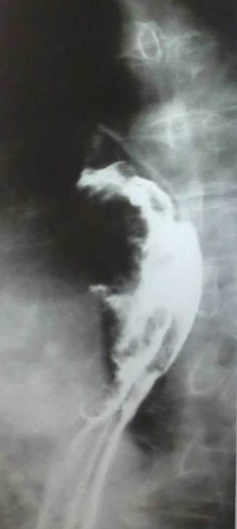 Incidencia oblicua ampliada del tránsito esofágico baritado, donde se observa en el tercio medio del esófago una imagen exofítica y ulcerada que disminuye parcialmente su luz. Dicho hallazgo se correspondió con un adenocarcinoma de esófago. Esta imagen nos recuerda al gran tiburón blanco, con su mandíbula abierta y sus afilados dientes.