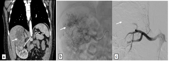 Reconstrucción coronal de tomografía en fase arterial (A), así como imágenes pre (B) y post EAR (C) en paciente con carcinoma renal de células claras del polo superior derecho (flecha en A), empleando técnica de embolización percutánea transcatéter por acceso femoral con micropartículas de PVA. Angiográficamente, la lesión tumoral presenta irrigación arterial aumentada y neoformada (flecha en B). El control post embolización demuestra resultado satisfactorio con oclusión del territorio vascular de interés y ausencia de contraste intraparenquimatoso (flecha en C).