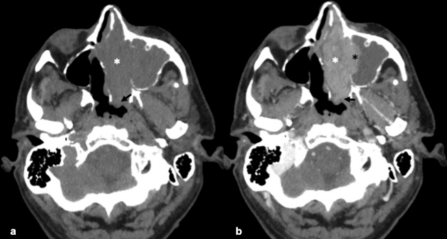 (a) TC craneoencefálica sin contraste intravenoso en plano axial. Lesión de tejido blando ocupante de espacio homogénea que ocupa fosa nasal izquierda (asterisco blanco) y presenta extensión coanal izquierda (flecha negra) y destrucción ósea con extensión a seno maxilar izquierdo (asterisco negro). (b) TC craneoencefálica con contraste intravenoso yodado en plano axial. Tras la administración de contraste, la lesión presenta un realce moderado.