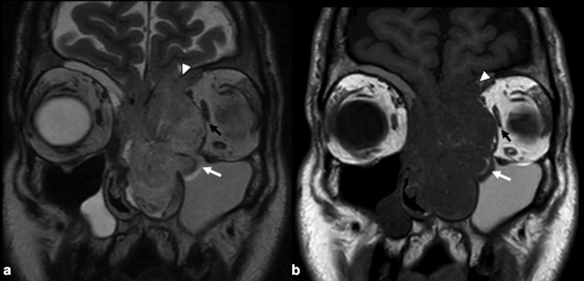 RM craneoencefálica en plano coronal. (a) Secuencia potenciada enT2 y (b) Secuencia potenciada en T1. Lesión ocupante de espacio de intensidad discretamente heterogénea de predominio hiperintenso respecto a la sustancia gris en secuencia potenciada en T2 y señal levemente hipointensa en secuencia potenciada en T1, que ocupa la fosa nasal izquierda y presenta destrucción ósea con destrucción de la lámina papirácea izquierda, extensión intraorbitaria izquierda extraconal con compresión del músculo recto interno izquierdo sin aparente infiltración del mismo (flecha negra), extensión infundibular a pared medial de seno maxilar izquierdo (flecha blanca), destrucción del suelo del seno frontal izquierdo con extensión al mismo, destrucción de la lámina cribiforme izquierda con extensión intracraneal extraaxial en fosa anterior frontobasal izquierda, que parece contenida por la duramadre, apreciando dudosa disrupción dural que podría traducir una mínima ocupación del espacio subdural (punta de flecha blanca).